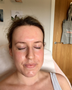 After the treatment - glowing skin!